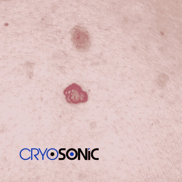 Looking for pain free cherry angioma removal treatment Folkestone? Call our team today! Folkestone