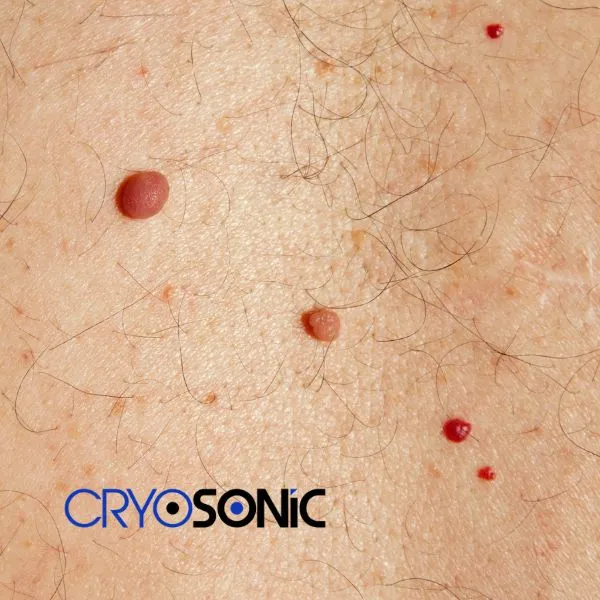get cherry angioma removal treatment today! Folkestone