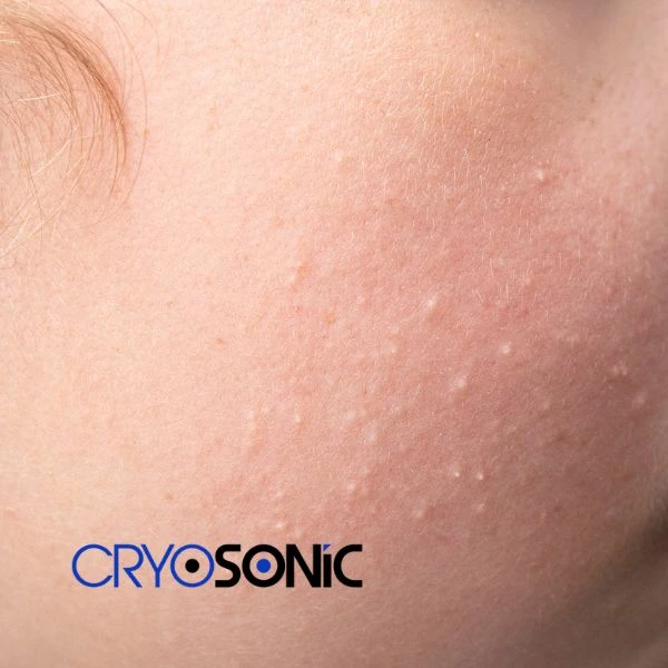 Are you looking for milia removal treatment? Contact our team today Folkestone