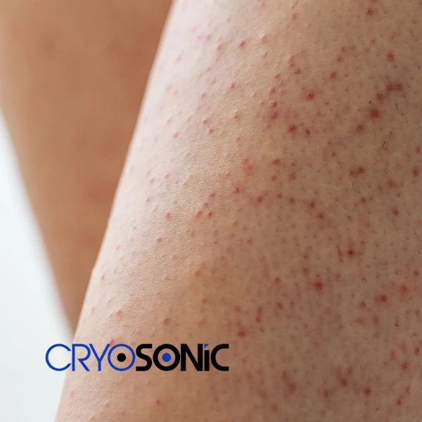Looking for Seborrhoeic Keratosis removal Folkestone treatment? Call our consultants today in Folkestone
