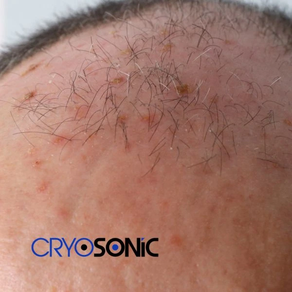 Access Seborrhoeic Keratosis removal from the comfort of your own home! Call us today in Folkestone