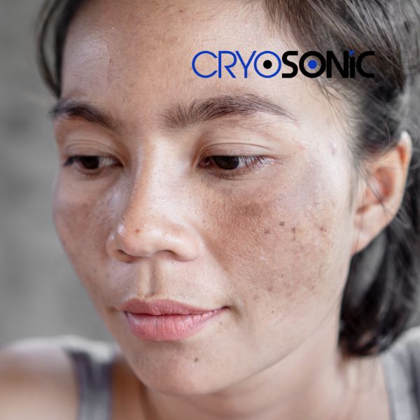 Ready to start age spots removal? Contact our team today in Folkestone