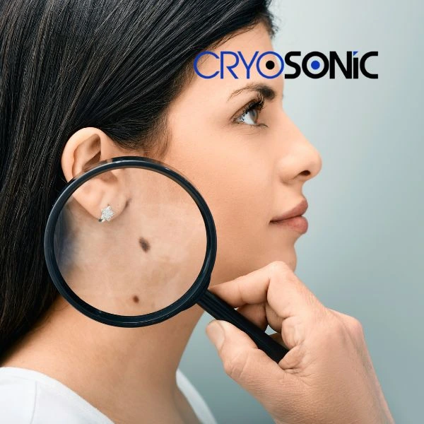 Do you want to learn more about benign moles removal treatment? Call our team today Folkestone