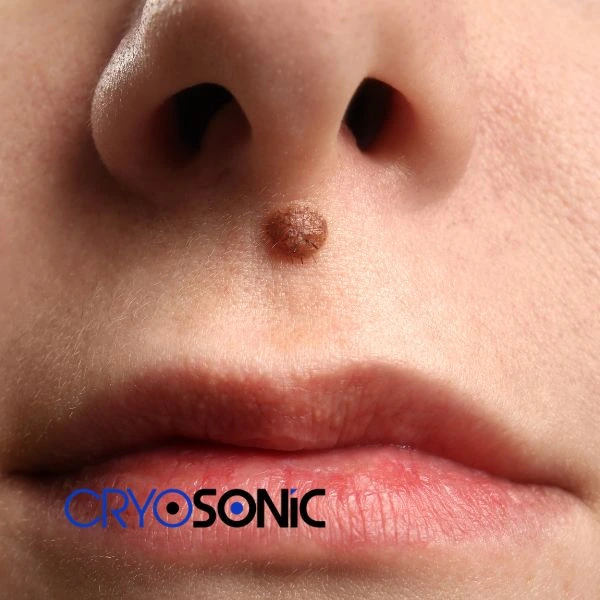 Start your benign moles removal treatment today Folkestone