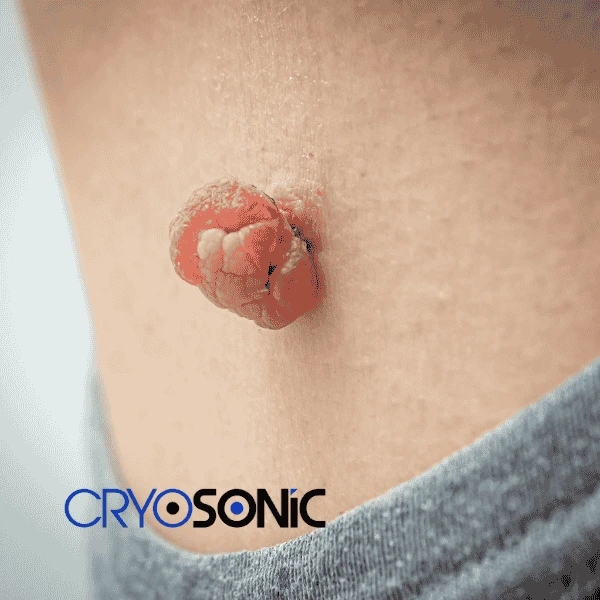 Book your skin tags removal Folkestone from comfort of your own home! Folkestone