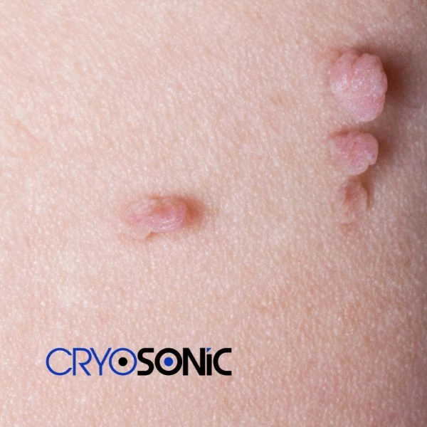 Are you looking for fast effect skin tag removal Folkestone? Book in NOW! Folkestone