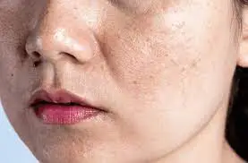 When will I see the results? Understanding healing, scabbing, scar prevention, and pigmentation changes Folkestone