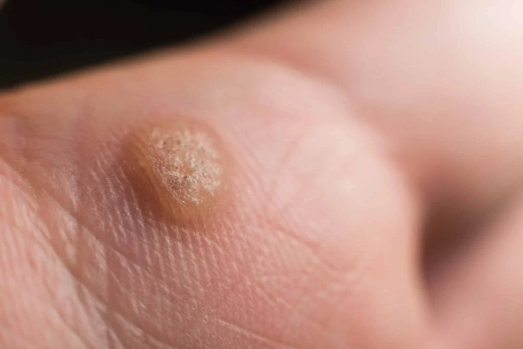 CryoPen treatment for Common Warts showing precise freezing of viral skin lesions for safe and effective removal Folkestone