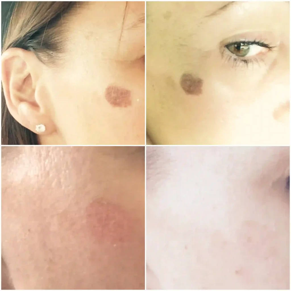 How long do pigmentation changes usually take to fade Folkestone