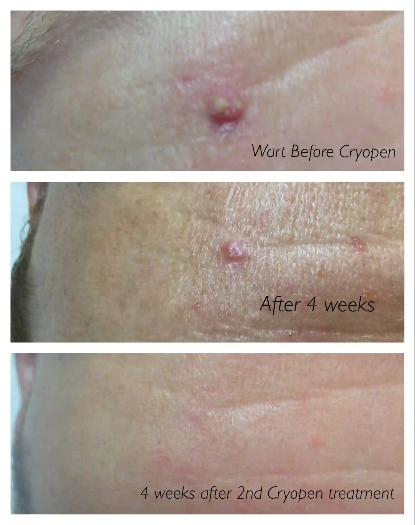What early healing signs should I expect immediately after treatment Folkestone