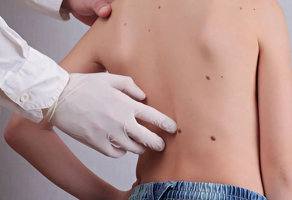 Safe Ways to Remove Skin Tags in Children Folkestone